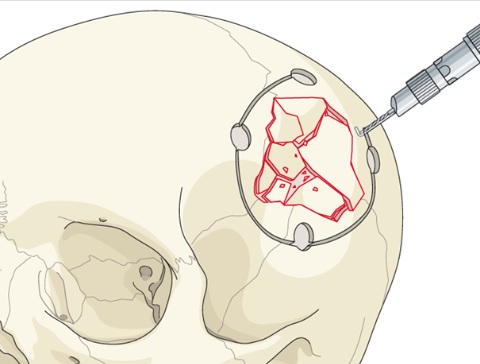 Surgical repair of a depressed skull fracture. The affected bone block is removed so that fragments can be cleaned and realigned. The pieces are then fixed to each other and securely reattached to the surrounding skull.