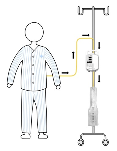 Schematic drawing of pump-regulated volumetric continuous lumbar drainage. Arrows indicate the direction of cerebrospinal fluid drainage.