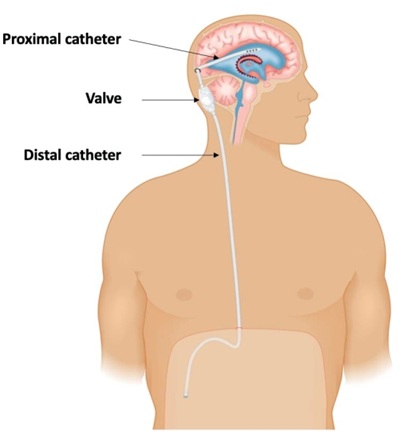 The illustration shows a ventriculoperitoneal (VP) shunt placed for hydrocephalus, which drains excess cerebrospinal fluid (CSF) into the abdominal cavity. The components of the shunt include a ventricular catheter, a programmable valve—designed to precisely regulate CSF drainage to prevent both under-drainage and over-drainage—and a distal catheter that routes the fluid from the valve into the abdomen.