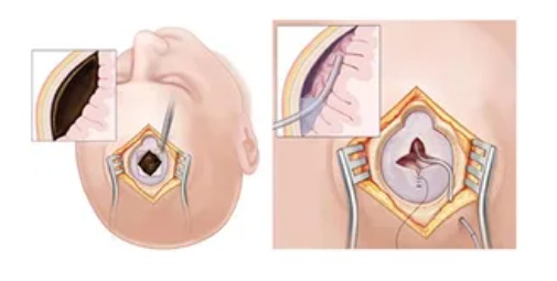 Chronic Subdural Hematoma Surgery The image on the left shows a trepanation (the creation of small holes in the skull, known as burr holes) and the hematoma before evacuation and irrigation. The image on the right shows the hematoma after removal, with a drain placed in the remaining cavity, which will stay in place for 2 days.