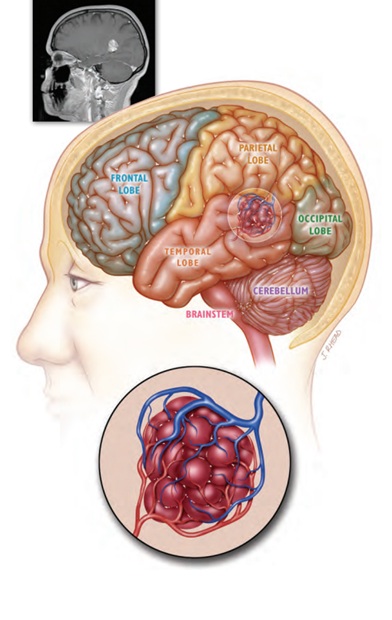 Temporal lobe cavernoma composed of clusters of dilated, thin-walled capillary-type channels. The 'bumpy' purple surface is why these lesions are often compared to a raspberry or mulberry.