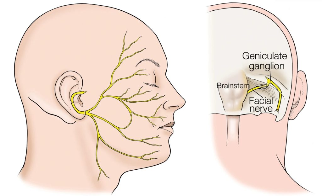 The image on the right shows the facial nerve (CN VII) originating from the brainstem and entering the facial canal within the petrous part of the temporal bone. The image on the left displays the facial nerve after exiting the canal, branching out to provide innervation to the muscles of facial expression.