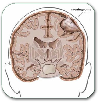 A meningioma growing from the coverings of the brain and compressing surrounding parts of the brain, without infiltrating them.