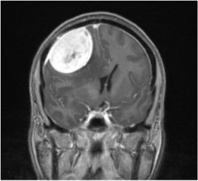Brain MRI showing a meningioma in the right parietal region, causing a significant mass effect on the brain due to its size and surrounding edema.