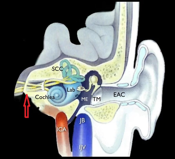 The red arrow indicates the vestibulocochlear nerves as they enter the internal auditory meatus (inner ear).