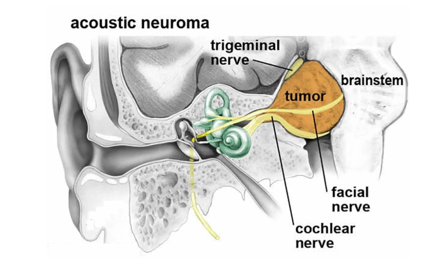 Large vestibular schwannoma (>3 cm) extending from the internal auditory canal into the cerebellopontine angle. At this size, the tumor may compress the facial nerve, trigeminal nerve, and brainstem. Radiosurgery is typically more suitable for smaller tumors, while larger lesions often require microsurgical removal. As tumor size increases, surgical complexity and the risk of incomplete functional recovery may also increase.