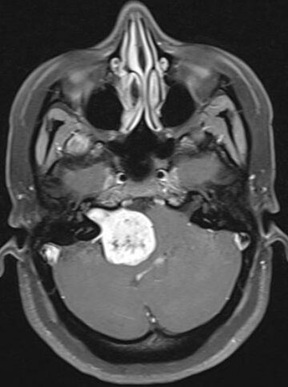 MRI scan (T1-weighted with contrast) showing a bright vestibular schwannoma with a characteristic 'ice cream cone' appearance. The narrow portion (the cone) is located within the internal auditory canal, while the wider portion (the scoop) extends into the cerebellopontine angle between the brainstem and the cerebellum.