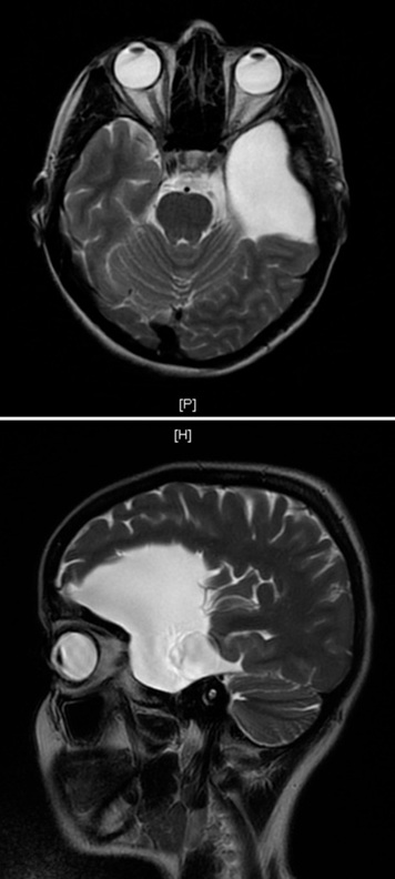 MRI scan showing an arachnoid cyst in the temporal region (temple area). On this scan, the cyst appears as a bright white area.