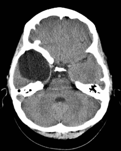 CT scan of the brain showing a right temporal arachnoid cyst.