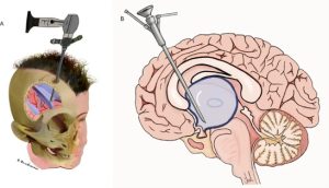 Arachnoid Cyst: Do You Need Surgery? Symptoms & Treatment