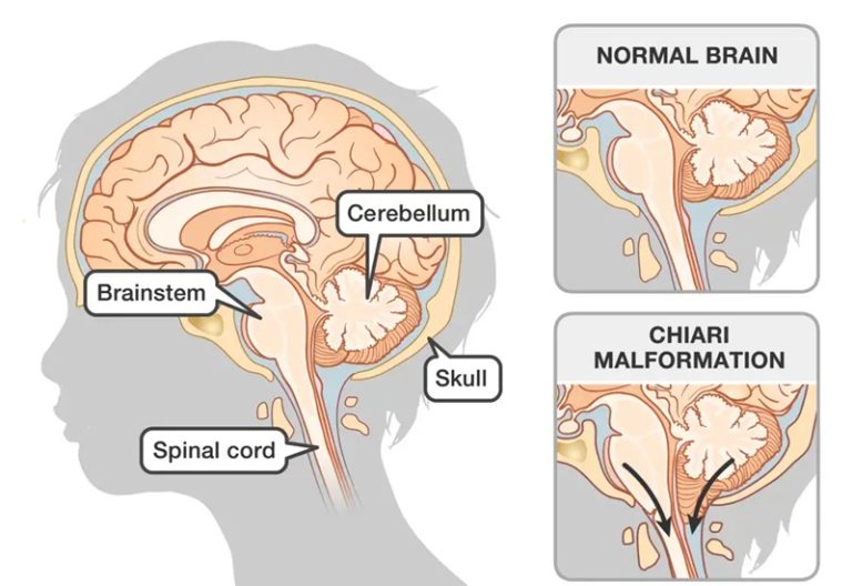 Chiari Malformation in Adults: Diagnosis, Monitoring & Surgery