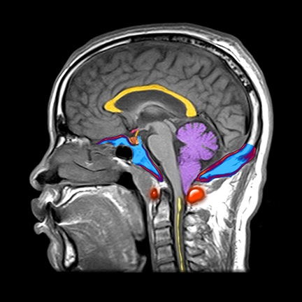 Sagittal MRI view showing the cerebellar tonsils (purple) descending through the foramen magnum (blue), compressing the brainstem and the upper spinal cord.
