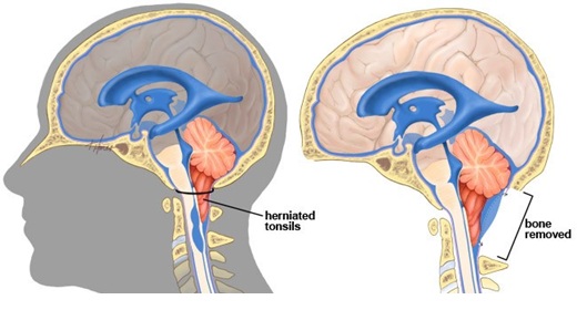 On the left, the descended tonsils are visible as part of a Chiari malformation. On the right, the removal of a portion of the bone is shown, creating space for the tonsils to relieve pressure on the spinal cord. If this is not sufficient, depending on the surgeon's assessment and preference, the procedure can be expanded to include opening and enlarging the brain’s lining (dura) with a patch, releasing the tonsils from adhesions, reducing the tonsils through coagulation (shrinking), or even removing the tonsils entirely.