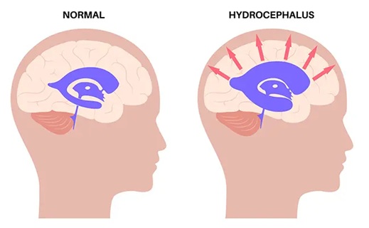 On the left, normal ventricles are shown; on the right, they are enlarged due to an obstruction of cerebrospinal fluid flow, a condition known as hydrocephalus.