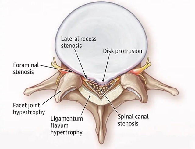 Narrowed sections of the spinal canal (central canal, lateral recess) and foramina due to degenerative changes (osteophytes from the vertebral bodies anteriorly and the facets posteriorly, as well as an enlarged ligamentum flavum).