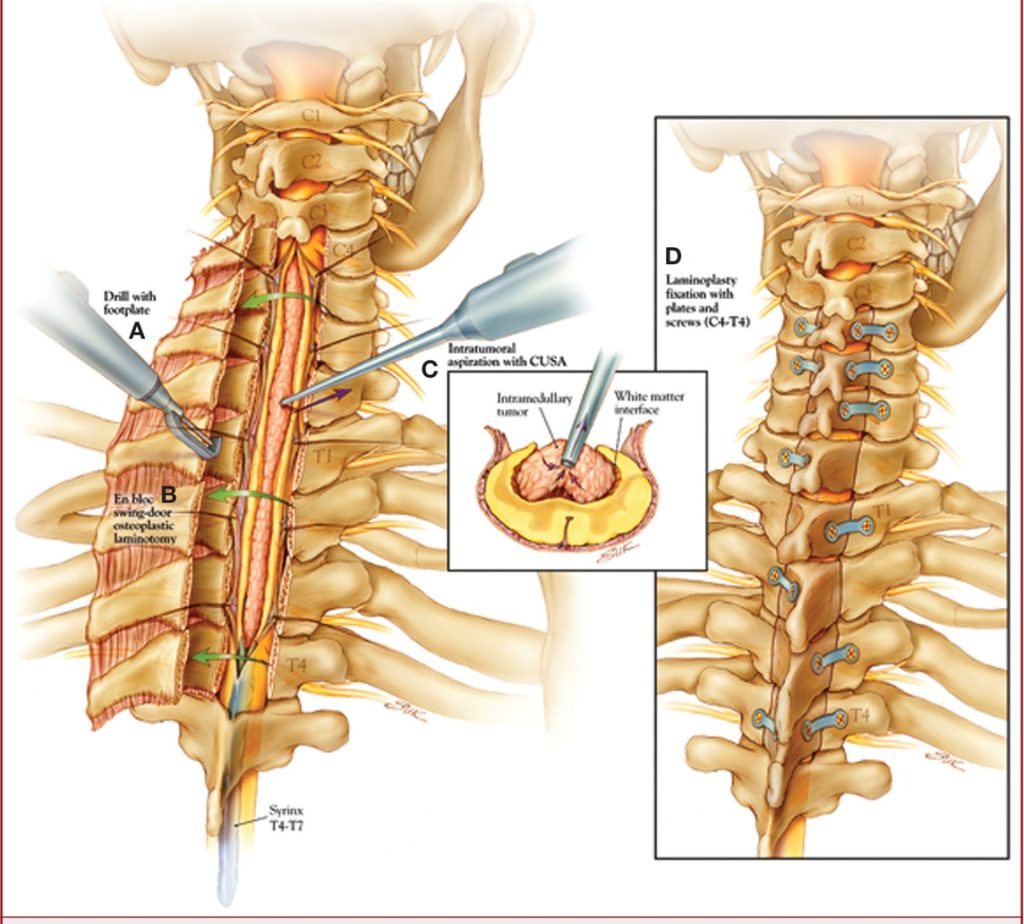 The image on the left shows the removed posterior arches of the spinal canal (laminae) to access the spinal cord. The dura mater (the spinal cord’s protective envelope) is opened, followed by a midline incision of the spinal cord to reach the tumor. Whenever possible, the tumor’s margin is identified, and it is separated from the spinal cord and removed (in this case, using a specialized surgical aspirator called CUSA). The entire procedure is performed under general anesthesia with neurophysiological monitoring, which tracks the spinal cord pathways to ensure they are not damaged during manipulation. After the tumor is removed, the dura is sutured, and the laminae are re-fixed (laminoplasty, as shown in the image on the right).
