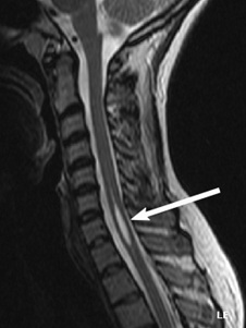 MRI of the cervical spine. The arrow points to a syrinx within the spinal cord."