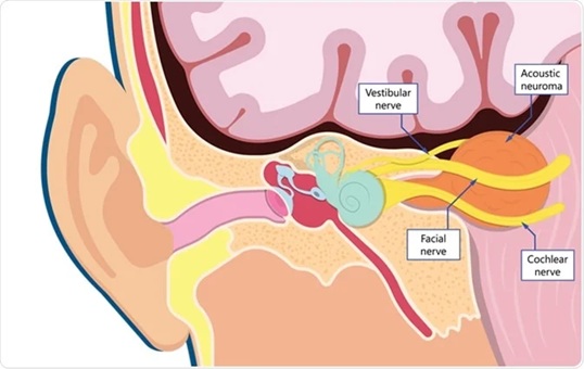 Vestibular schwannoma growing from the internal auditory canal and extending into the space between the cerebellum and the brainstem. The internal auditory canal runs from the middle ear and houses the facial nerve and the 8th cranial nerve. The 8th nerve consists of an acoustic part and a vestibular part responsible for balance. A schwannoma most commonly grows on the vestibular portion.