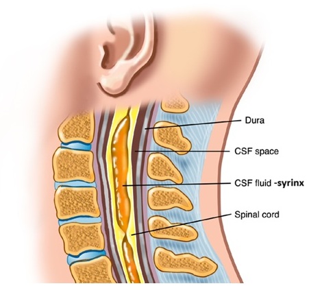A syrinx filled with spinal fluid (CSF) within the cervical spinal cord.