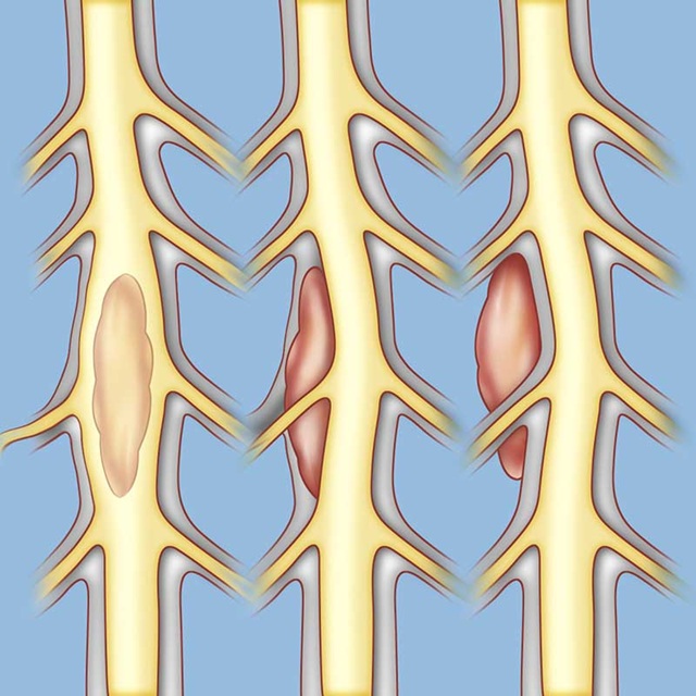 Spinal tumors can be located in three different areas (from left to right): intramedullary (inside the spinal cord, e.g., ependymoma or astrocytoma), intradural-extramedullary (inside the spinal membrane but outside the cord, e.g., meningioma or schwannoma), or extradural (outside the spinal membrane, e.g., bone metastases or vertebral tumor).