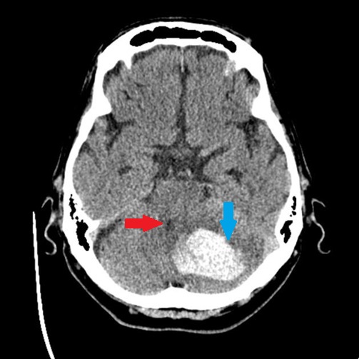 Brain CT scan shows a bright hematoma (blue arrow) in the left cerebellar hemisphere, partially compressing the 4th ventricle (red arrow) and threatening to cause acute hydrocephalus if the mass effect increases.