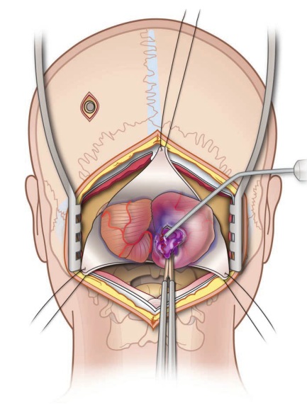 ISurgery for an intracerebral hematoma of the right cerebellar hemisphere — the skin and muscles of the posterior neck are incised and retracted, the occipital bone is removed, and the dura mater (the protective outer covering of the brain) is opened and suspended; the cerebellar surface is then carefully incised to reach and evacuate the hematoma, followed by meticulous hemostasis (control of bleeding to prevent re-bleeding), after which the dura is closed in a watertight fashion (to prevent cerebrospinal fluid leakage), the bone is replaced if there is no significant swelling, and the muscles and skin are sutured.