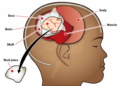The image illustrates a craniotomy. Both the skin incision and the skull opening are performed within the hair-bearing area of the scalp. The dura is opened to expose the tumor or the brain as part of the surgical approach to the tumor. After the procedure, the bone flap is secured and the scalp is reconstructed, ensuring no cosmetic defect remains after healing.