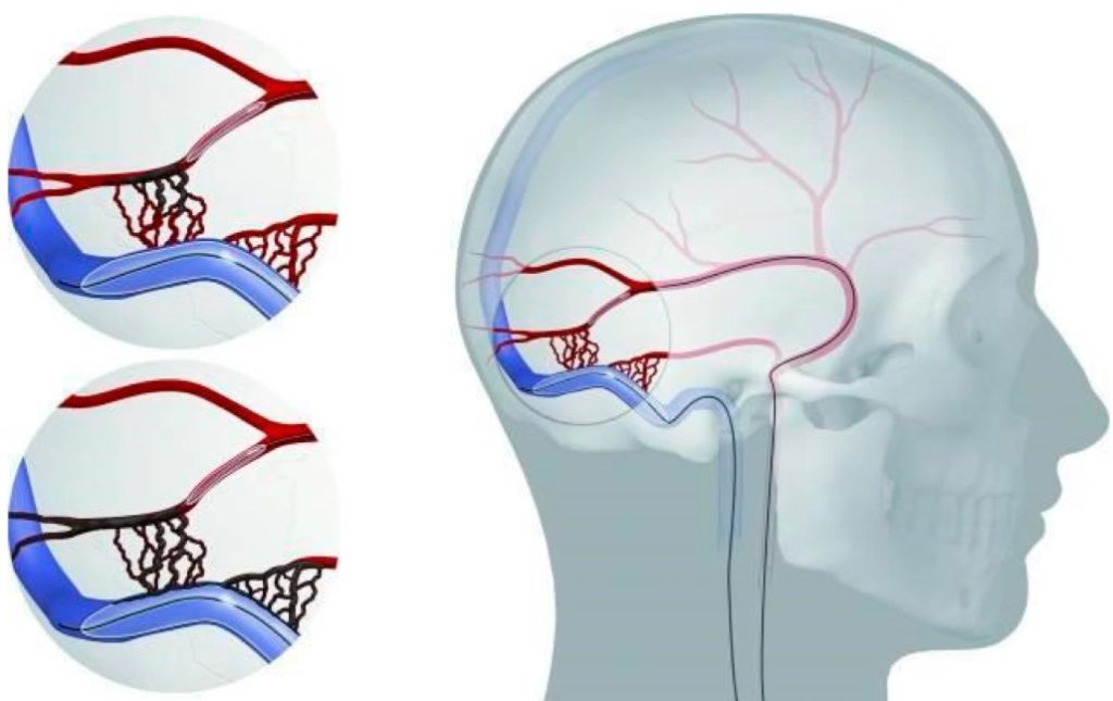 Schematic illustration of an occipital dAVF and its management via combined transarterial and transvenous endovascular occlusion.