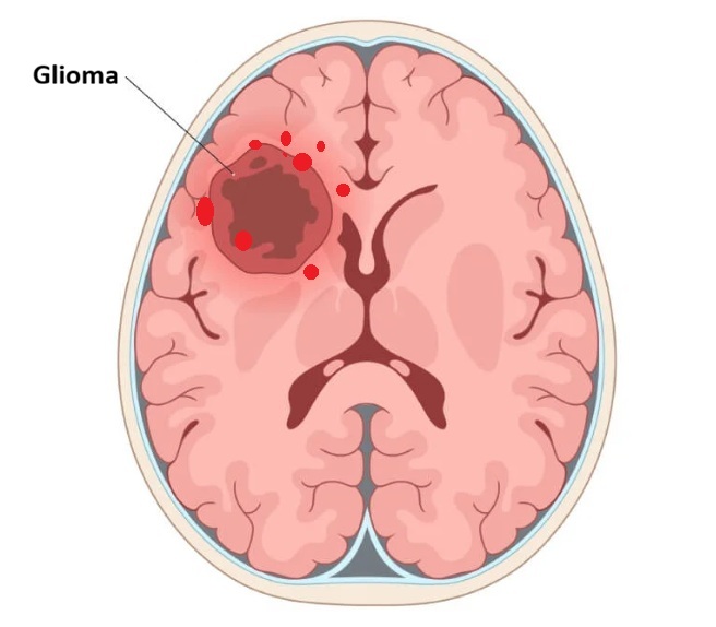 Illustrating diffuse brain infiltration by a glioma. This microscopic spread makes it impossible to define a precise boundary between the tumor and healthy tissue during surgical resection.