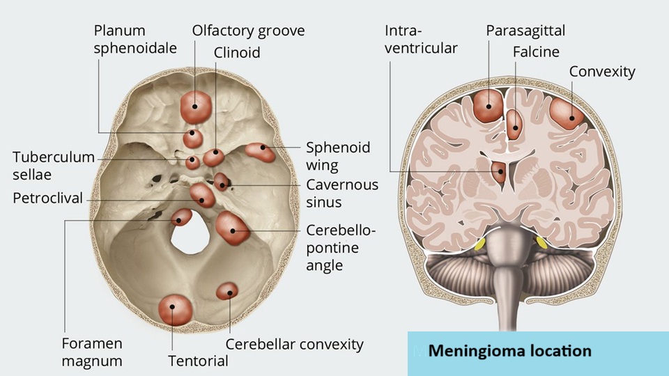 Sphenoid wing meningiomas and meningiomas of other locations