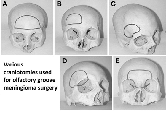 Various locations and sizes of craniotomies can be used for olfactory groove meningioma surgery, depending on the tumor's size, its dominant growth direction, or the surgeon's preference.