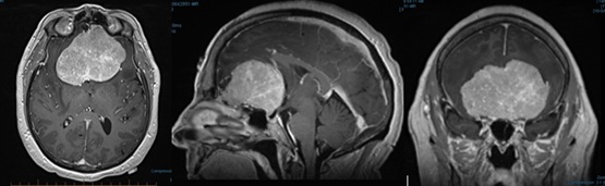 A T1-weighted contrast-enhanced MRI shows a large olfactory groove meningioma in three planes as a bright (enhancing) tumor.