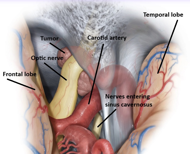 View of a medial sphenoid wing tumor between the retracted frontal and temporal lobes. The tumor is seen compressing the optic nerve and the carotid artery, as well as the cavernous sinus, which already contains the nerves responsible for eye movement and facial sensation.