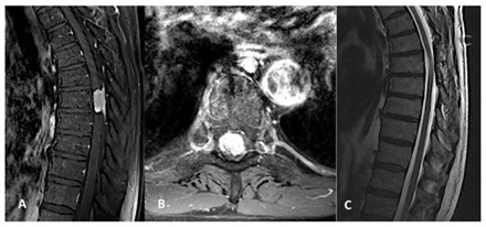 A and B show a contrast-enhanced MRI of the thoracic spine, revealing a bright (enhancing) meningioma within the spinal canal compressing the spinal cord. Image C shows the postoperative state after gross total resection (complete surgical removal) of the meningioma.