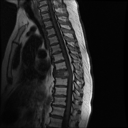 Spine MRI shows a tumor (metastasis) in the Th8 vertebra that caused the bone to collapse. A piece of the broken bone is pushed backward, causing significant pressure on the spinal cord.