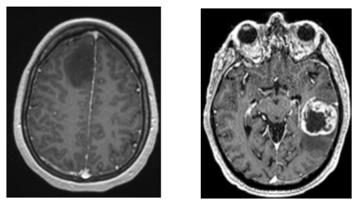 Left: A Grade 2 astrocytoma (no contrast uptake). Right: A more aggressive Grade 4 tumor, which appears bright white after contrast injection and shows a dark area of necrosis in the middle.
