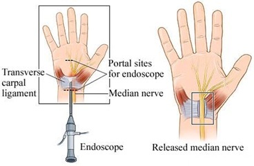 Carpal tunnel release surgery aims to relieve pressure on the median nerve by cutting the ligament. This can be achieved using a traditional mini-open incision or a minimally invasive endoscopic technique.