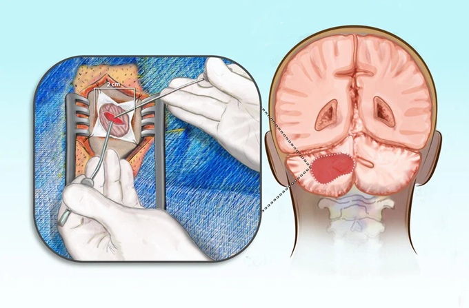 The image on the right shows a hematoma in the left cerebellar hemisphere, and the one on the left shows its surgical evacuation.