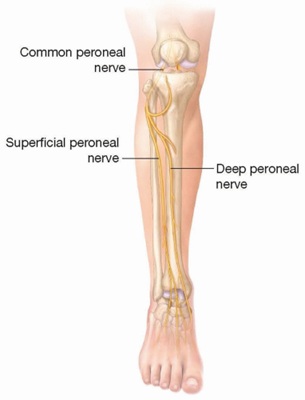The common peroneal nerve travels behind the knee before curving around the bony prominence on the outer side of the leg (the fibular neck). Because the nerve lies very close to the skin at this specific point, it is easily compressed by tight clothing, leg crossing, or external pressure.