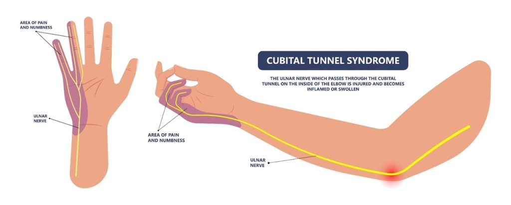 Ulnar nerve course at the elbow — the region where compression typically occurs.