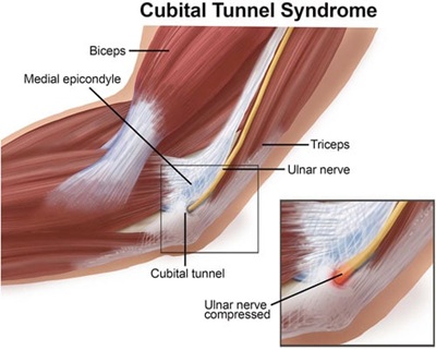 Cubital tunnel syndrome anatomy