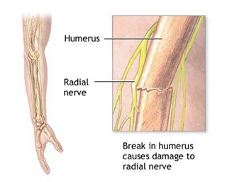 A humerus fracture causes injury to the radial nerve