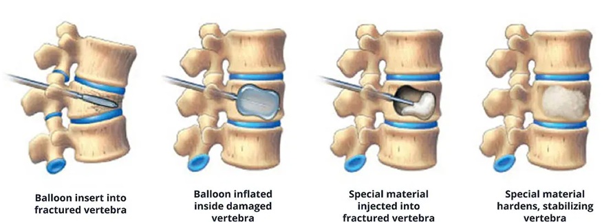 Steps of the kyphoplasty procedure following a vertebral compression fracture. Balloon expansion inside the collapsed vertebra partially corrects the spinal deformity; afterward, the cavity is filled with bone cement.