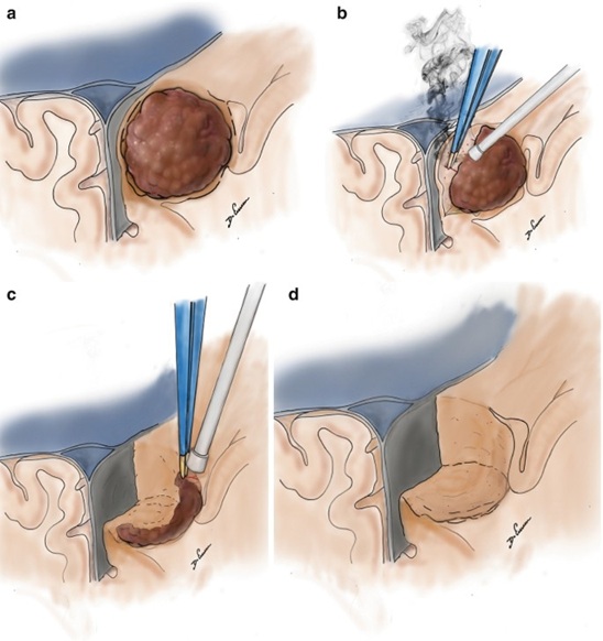Stages of surgical removal of a parasagittal meningioma. After craniotomy and opening of the dura, image (a) shows the dark brown parasagittal meningioma. Image (b) illustrates its separation from the brain, sagittal sinus, blood vessels, and other normal tissues, followed by its piecemeal reduction. Image (c) shows the removal of the remaining peripheral parts of the meningioma. Image (d) shows the condition after the meningioma has been completely removed.