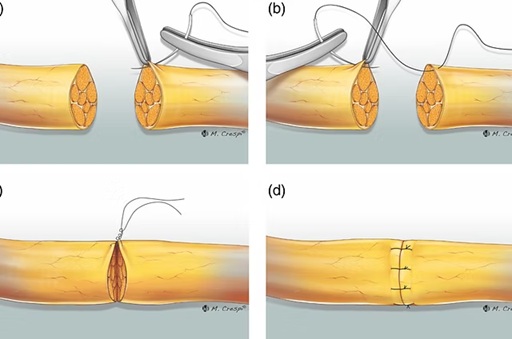 direct nerve suturing