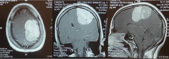 Contrast-enhanced T1-weighted brain MRI showing a large, bright parasagittal meningioma in three projections.