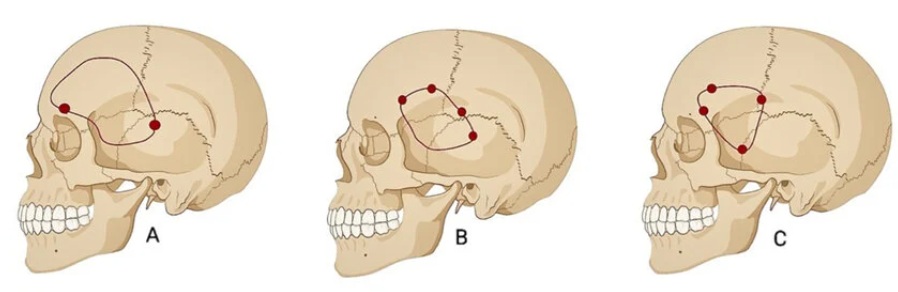 Various types of pterional craniotomies can be used for sphenoid wing meningioma surgery, depending on the tumor’s size, its dominant growth direction, or the surgeon’s preference.