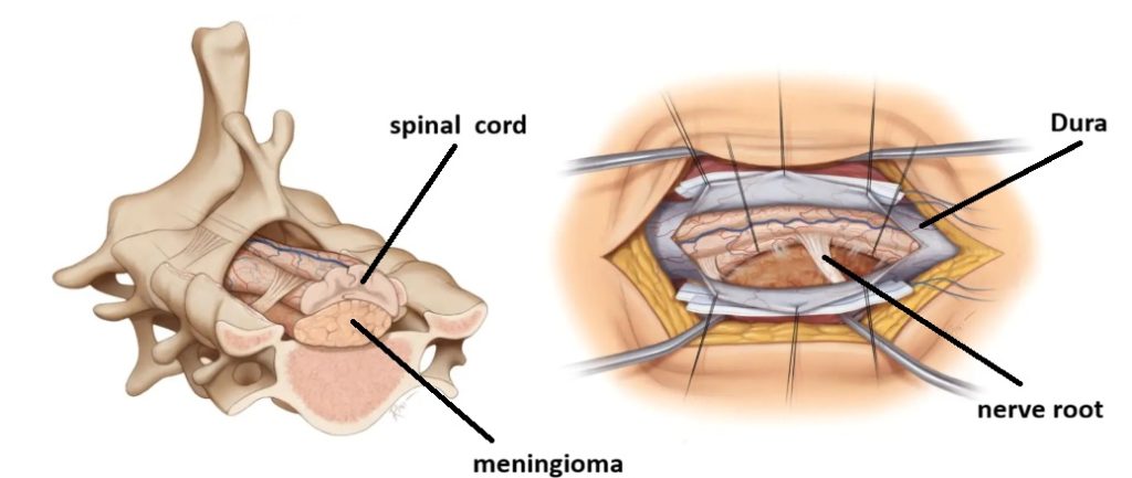 Surgery for a spinal meningioma. Shown are the skin incision, the removed laminae (laminectomy), and the opened dura mater. It displays the spinal cord, nerve roots, and the meningioma, which arises from the anterior and right lateral aspects of the dura, compressing the spinal cord.