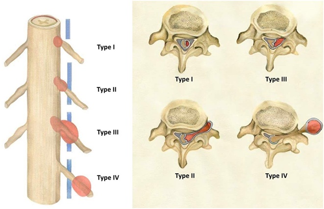 Shows different types of spinal schwannomas. Depending on their origin, growth direction, and size, they can be located strictly within the spinal canal, involve both the spinal canal and the foramen, extend through the spinal canal and foramen into the paraspinal space, or be located entirely outside the spinal canal.