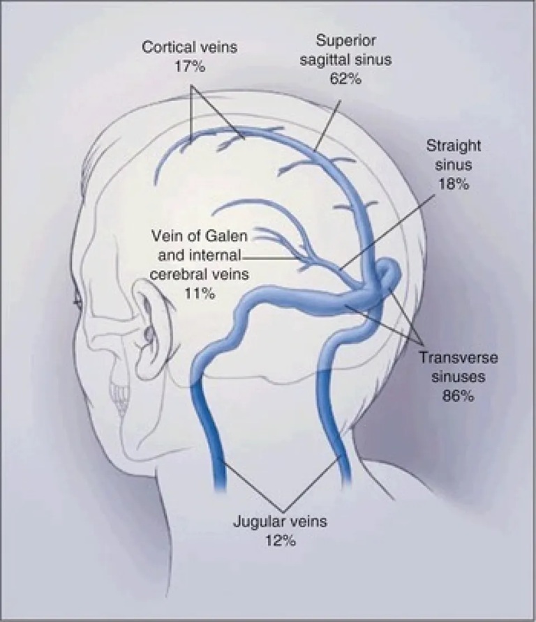 The superior sagittal venous sinus at the midline of the head with its venous tributaries. Parasagittal tumors can occur anywhere along this sinus, either pressing against its walls, infiltrating them partially, or obstructing them completely. If the sinus becomes gradually obstructed, its role in draining blood from the brain is taken over by the venous tributaries, which must therefore be preserved during surgery.